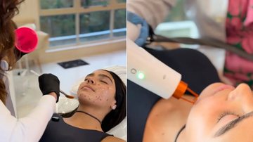 Duda Guerra fez procedimento para fechar poros e sinais provocados pela acne - Foto: Reprodução/Instagram