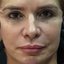 Mãe de Viih Tube realizou um facelift com células-tronco